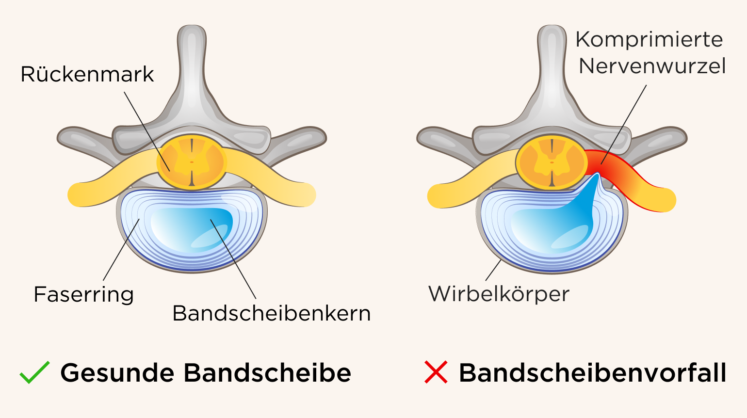 Kleiner Finger und Ringfinger taub HWS