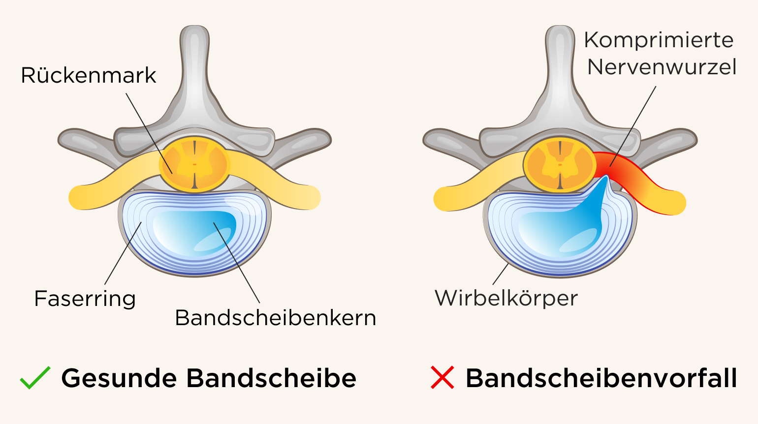 In der 1. Illustration ist eine gesunde, normale Bandscheibe zu sehen, inklusive Spinalkanal, Bandscheibenring und -kern. In der 2. Illustration ist ein Prolaps  zu erkennen, bei dem eine Nervenwurzel komprimiert wird.