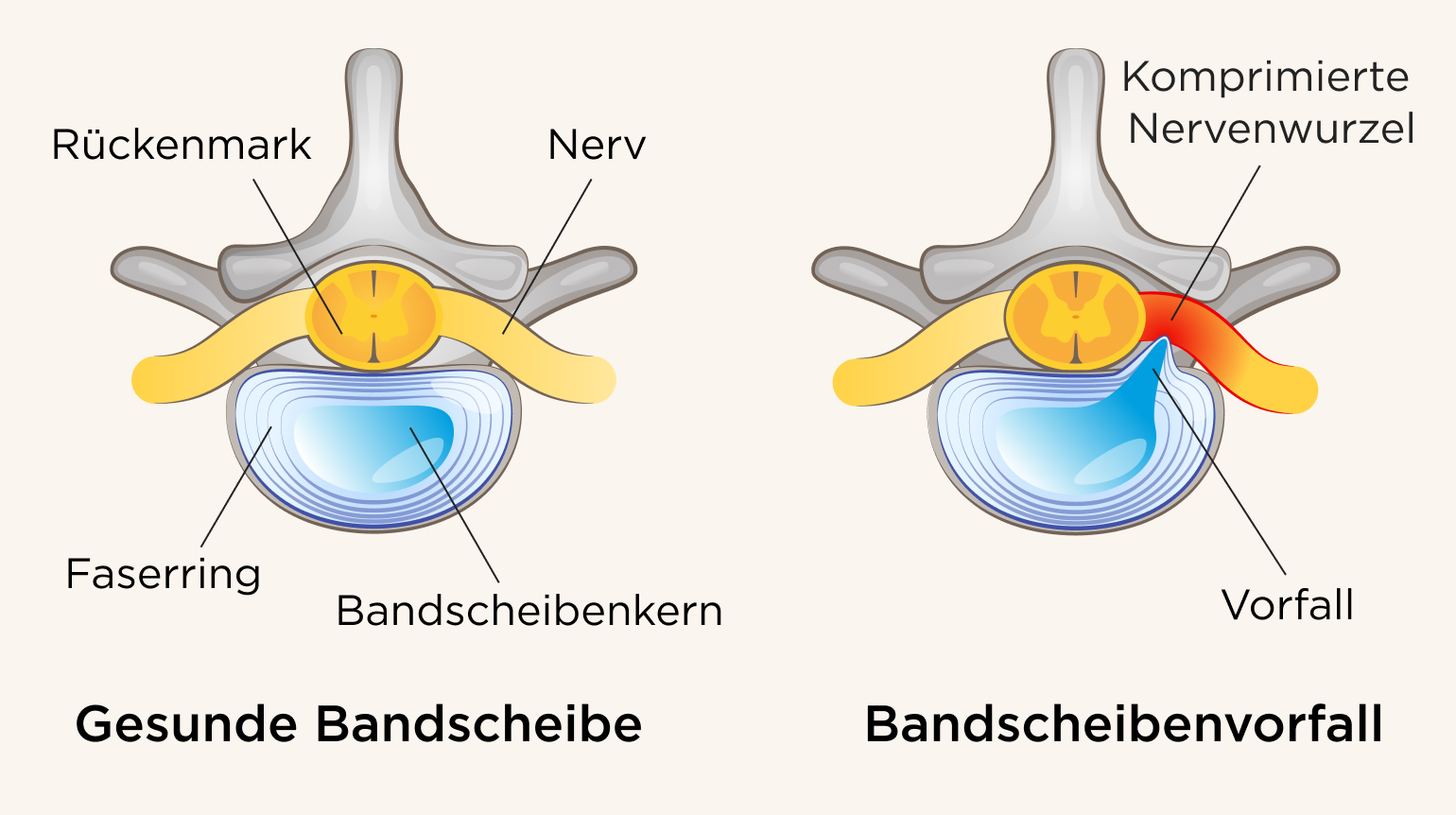 Bandscheibenvorfall_Illu-@2x