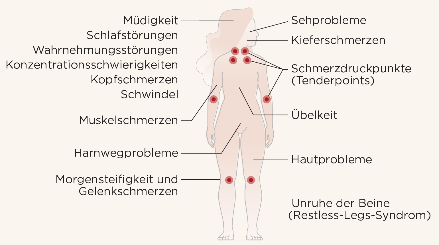 Illustration eines Körpers, auf dem 16 Fibromyalgie-Symptome markiert sind, von Kopfschmerzen und Sehproblemen über Muskelschmerzen und Übelkeit bis hin zu Gelenkschmerzen. Illustration eines Körpers, auf dem 16 Fibromyalgie-Symptome markiert sind, von Kopfschmerzen und Sehproblemen über Muskelschmerzen und Übelkeit bis hin zu Gelenkschmerzen.