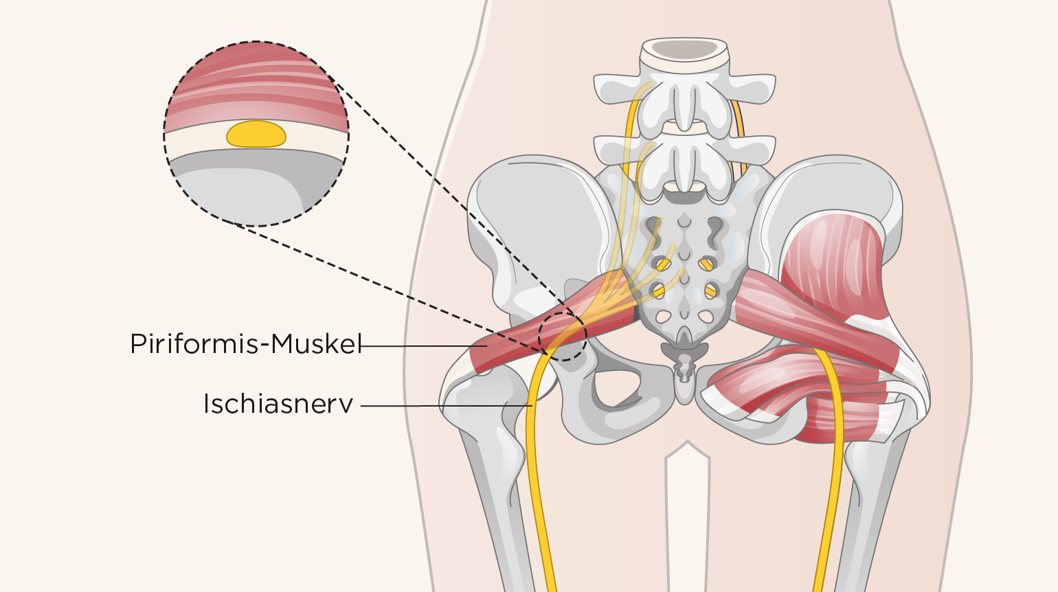 Illustration einer anatomischen Darstellung der Hüfte mit Becken, Sitzbein- und Oberschenkelknochen, Ischiasnerv verläuft unterhalb von Piriformis-Muskel Illustration einer anatomischen Darstellung der Hüfte mit Becken, Sitzbein- und Oberschenkelknochen, Ischiasnerv verläuft unterhalb von Piriformis-Muskel